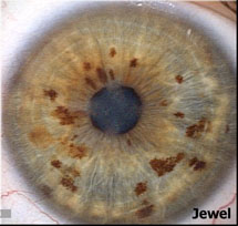 Jewel Eye Structure